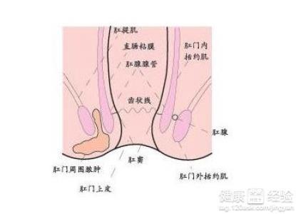 肛周脓肿手术创新技术解析